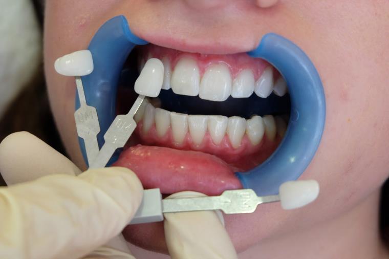 歯のホワイトニング-美容ケア