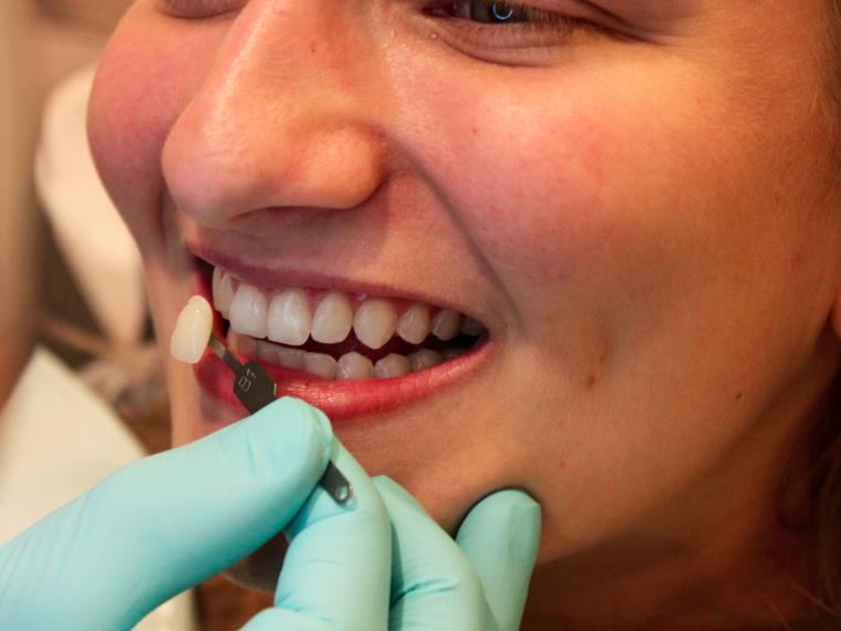 歯の色-歯科医-美しさ