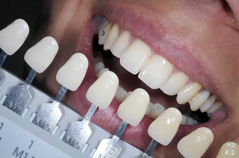 歯のホワイトニングカラー-歯-美容-歯科医