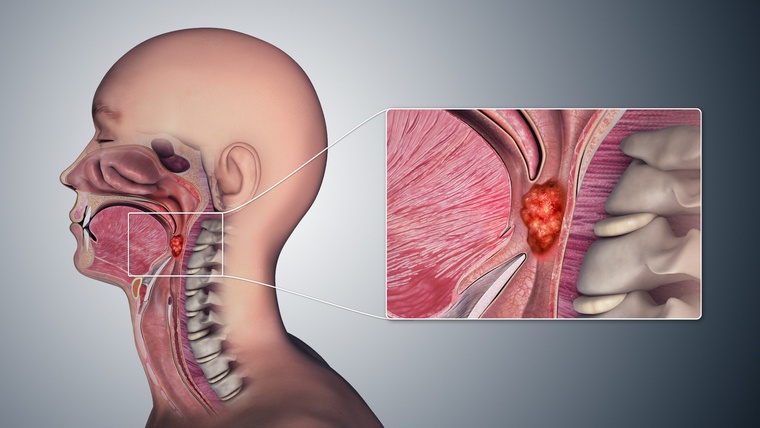 腫瘍の喉の永続的な痛み