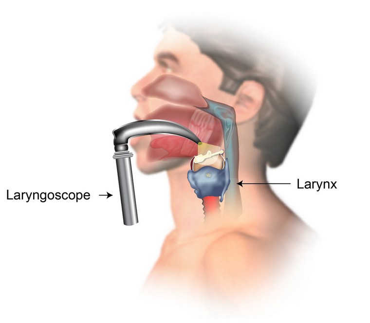 laringoskopija grlobolja liječiti